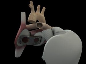 En 2013, la première greffe d’un coeur artificiel réussie !